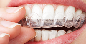 Invisalign Tray